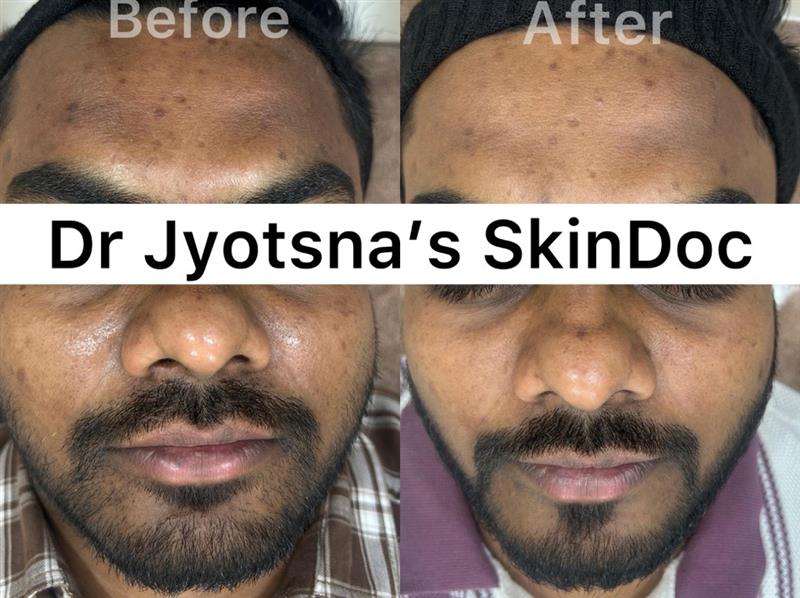 Carbon Laser Facial Before & After – SkinDoc Clinic