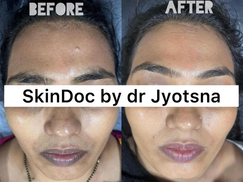 Chemical Peel Treatment Before & After – SkinDoc Clinic