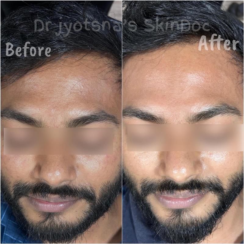 Chemical Peels Before & After – SkinDoc Clinic