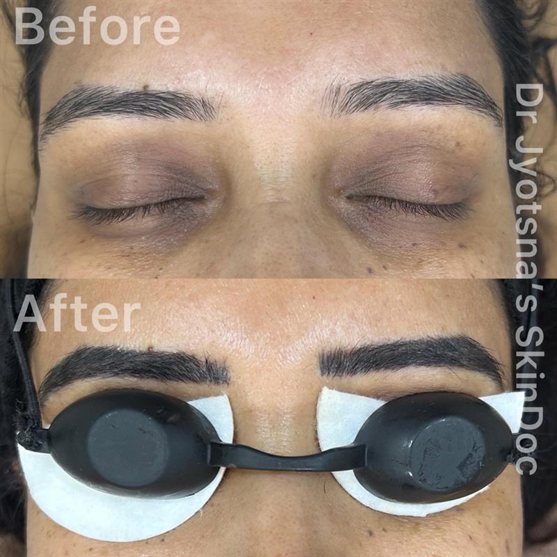 Eyebrow Microblading Before & After – SkinDoc Clinic
