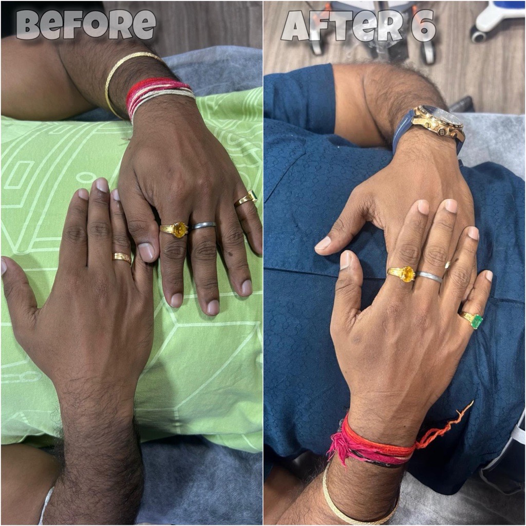 IV Glutathione Skin Brightening Before & After – SkinDoc Clinic