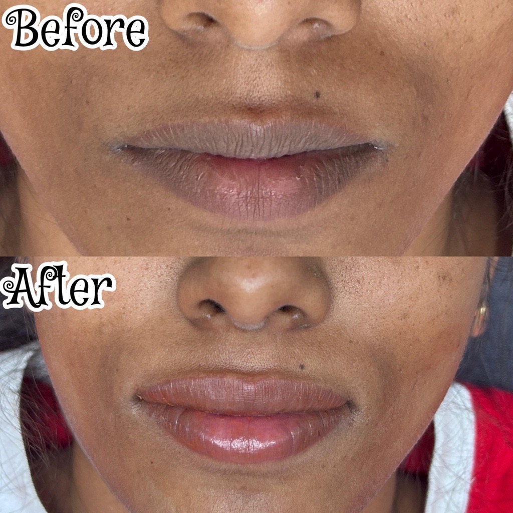 Lip Pigmentation Treatment Before & After – SkinDoc Clinic