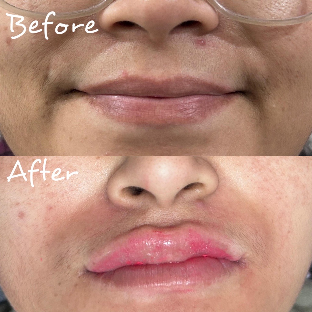 Lip Pigmentation Treatment Before & After – SkinDoc Clinic